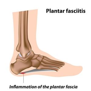 Heel Pain (Plantar Fasciitis)
